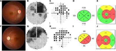 Leber’s hereditary optic neuropathy companied with multiple-related diseases